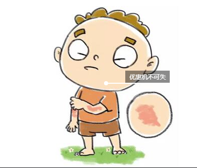 少年兒童患特應(yīng)性皮炎 少年兒童患特應(yīng)性皮炎