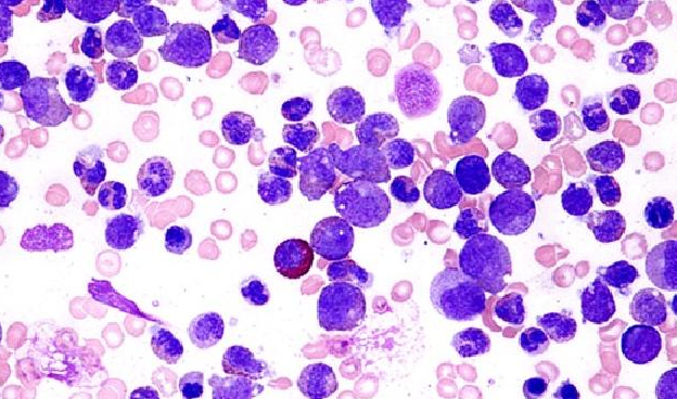 支原體交叉感染圖片 支原體交叉感染圖片